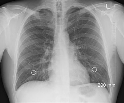 Misdiagnosis accident lawyers